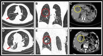 A case report of multiple artery pseudoaneurysms associated with SARS-CoV-2